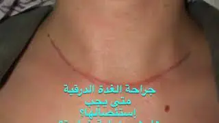 جراحة الغدة الدرقية متى يجيب إستئصالها؟ما هو شكل الرقبة بعد العملية؟أعراض ما بعد العملية؟