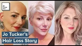Losing My Hair Changed My Thoughts On Beauty | Real Hair Stories