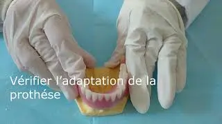La mise en place d'un attachement boule sur implant