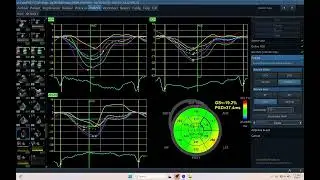 IQ 686 LVEF LVPSD LV GLS ECHOCARDIOGRAPHY PROCESS
