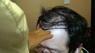 One Year Follow UP: Before and After Results by Dr. John Diep