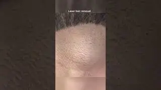 Can you use laser hair removal on your beard? mens laser hair removal