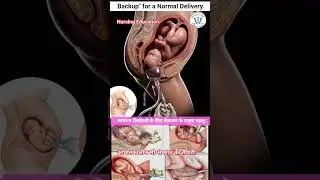 Normal Delivery का Backup Plan | Vacuum से C-Section तक#shorts,#virals