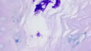 Helicobacter pylori with Alcian Blue and PAS Stain