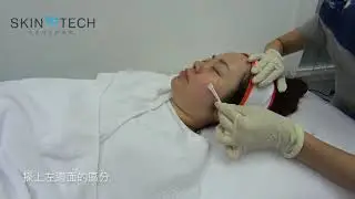 Skin Tech Phytic Peel Treatment