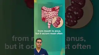 IBD or Crohn's Disease?! Dr. Sethi Shares the TRUTH!