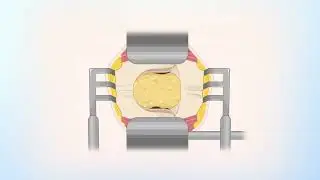 종사지방종(filum terminale lipoma) 애니메이션