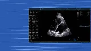 〖Echokardiografie〗 Parasternale lange Achse Hands-on - Pulmonalvenen & rechtsventrikul&auml;rer Einfluss