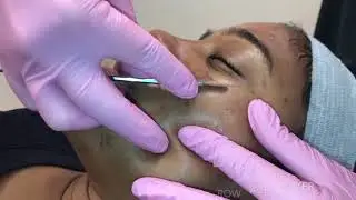 Dermaplaning at Pinski Dermatology & Cosmetic Surgery