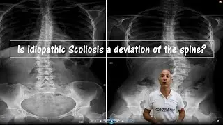 Escoliosis  Idiopática tratamiento sin corsé #corset #escoliosis