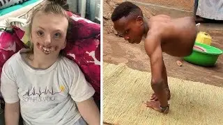 15 Rare Human Conditions That Created Famous Circus Freaks