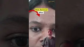 Face Mole Removal | Laser mole removal #shorts