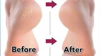 फटी एड़ियां होंगी मुलायम / 7Days Foot Cream For dry and Cracked Heels ||