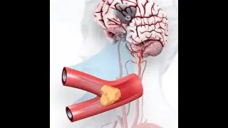 How to recognize a stroke #medical #stroke #strokerecovery #neurology #viral #doctor #education