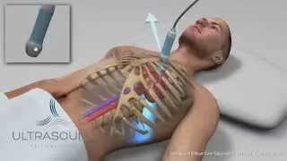 How to obtain: Parasternal Long Axis Ultrasound View - Training and Techniques - ICU
