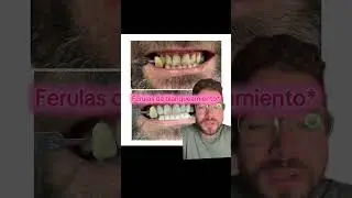 Te explico brevemente en que consiste un blanqueamiento dental #blanqueamientodental #zahnaufhellung