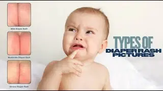 Diaper candidiasis; yeast diaper rash, common fungal infection in infants, caused by Candida albican