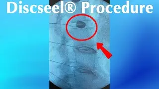 DISCSEEL против Deuk Laser Disc Repair&reg;: реальный пример на L3/L4 и L4/L5