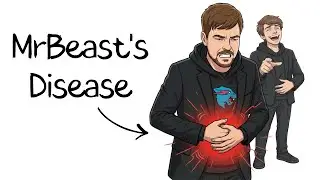 MrBeast's Disease Explained in 4 minutes
