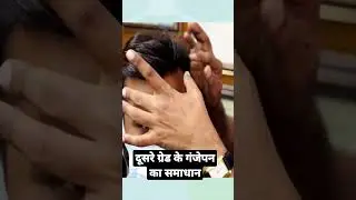 Solution of 2nd Grade Male Pattern Baldness#hairlosstreatment #baldnesssolution #vhcahairclinic