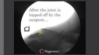 Shoulder Surgery Complications