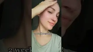 2 weeks using Dr. Dennis Gross Daily Peel