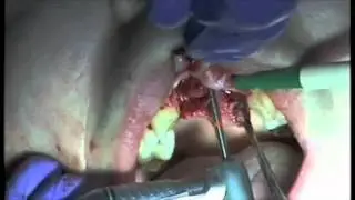 Stradbrook Implants:Troubleshooting failing implants- Mark Haswell