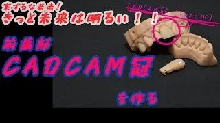 【歯科技工】IOSデータで前歯CADCAM冠を作る。しかもプリントモデルも作る。