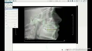 ORTOCERVERA / Ortodoncia: Cefalometría Cervera Resumida