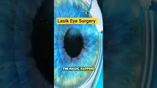 How LASIK Eye Surgery Is Performed #medical3danimation #3dmedicalanimation #lasikeyesurgery #lasik