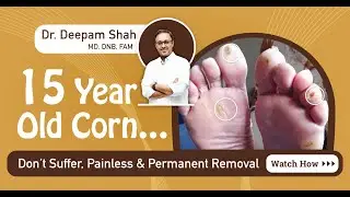 Laser Corn Removal | Foot Corn Treatment by Laser | Dr. Deepam Shah
