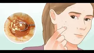Basmi Jerawat Dan Flak Hitam Sampai Ke Akar-akarnya Dengan Masker Sederhana Berikut Ini - Youtube