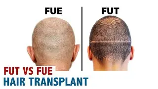 FUT vs FUE Hair Transplant