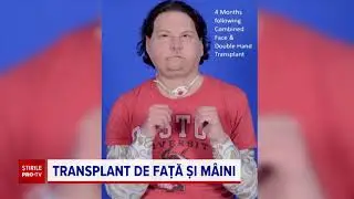 Medicii au reușit pentru prima dată un transplant simultan de față și mâini