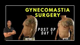 Gynecomastia: A Remarkable Transformation on Post-Op Day 1