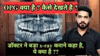 OPG क्या है ? कैसे देखते है ?OPG  क्यों कराया जाता है ?