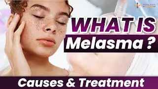 ✔What is Melasma? What are the Main Causes and Treatments of Melasma? | Home Care Tips #skindisease