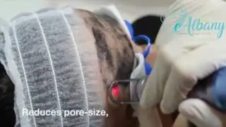 Carbon Peel