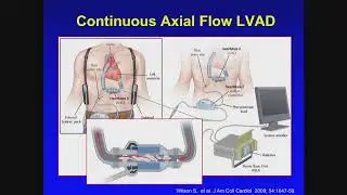 Mechanical Circulatory Support