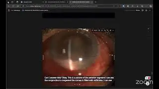 [MVUPGO 2025] Uveitis mock exam with Koushik Tripathy, India