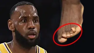 The TRUTH About LeBron James' Deformed Feet