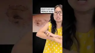 Why does your wound itch when it&rsquo;s healing?