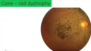 Lacture : Cone rod dystrophy a rare retinal condition
