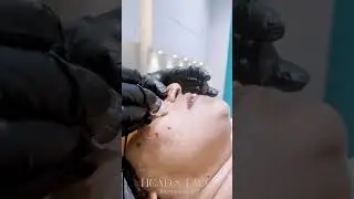 Crystal Dermalux Facial | Manju Pathrose| Blackies | #headandface #shorts#beauty #skincare