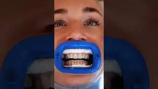 Medical teeth whitening in Berlin - my experience with gentle teeth whitening 🦷✨