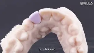EMAX AESTHETIC CROWN TO MATCH WITH THE WHOLE OCCLUSION