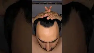 Primer Mes Usando Minoxidil