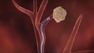Electromagnetic Navigation Bronchoscopy&trade; Procedure Video