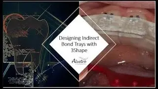 Designing an Indirect Bond Tray using 3Shape