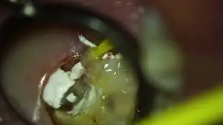 Extreme pre endo build up case 👍